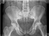 Hip X-Ray shr  30 3 10.shr jpg.jpg